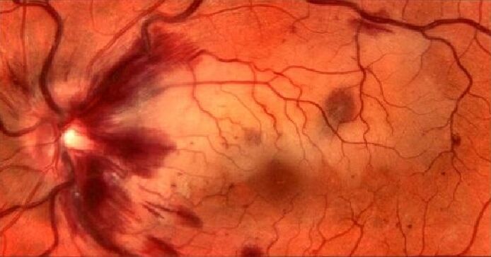 Blood vases of the retina and restoration of vision